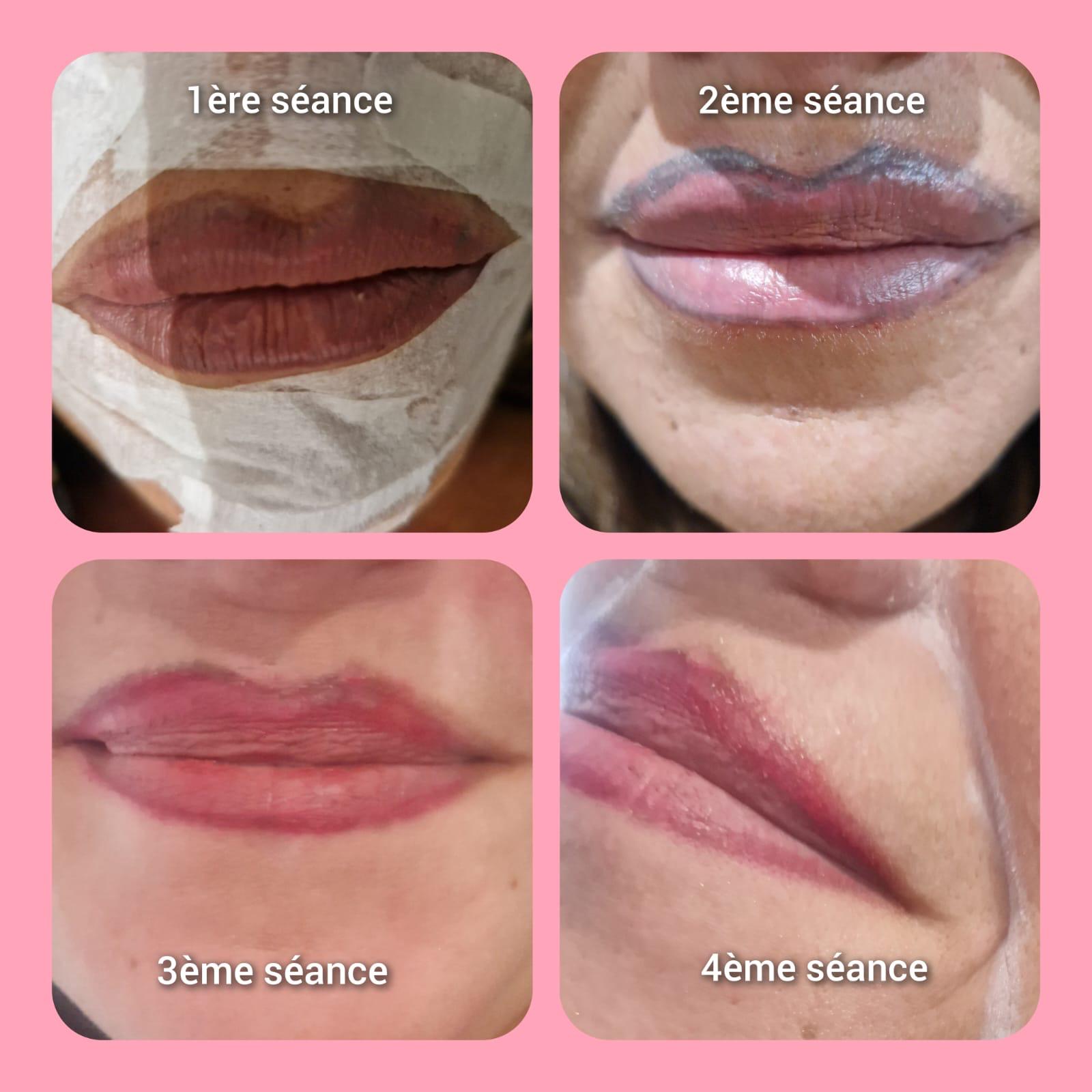 détatouage lèvres détatouage lèvres